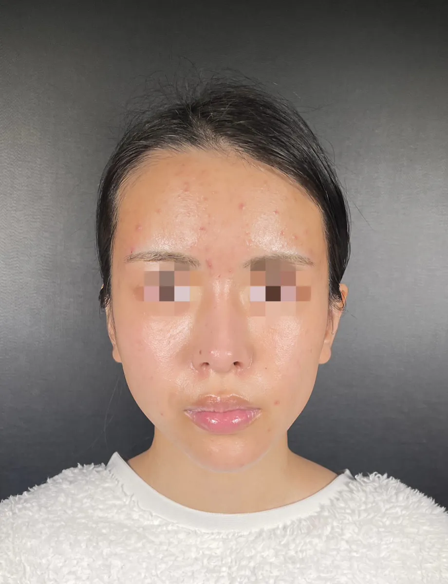 額縮小術後の傷痕経過―時間とともにどのように変化するのか