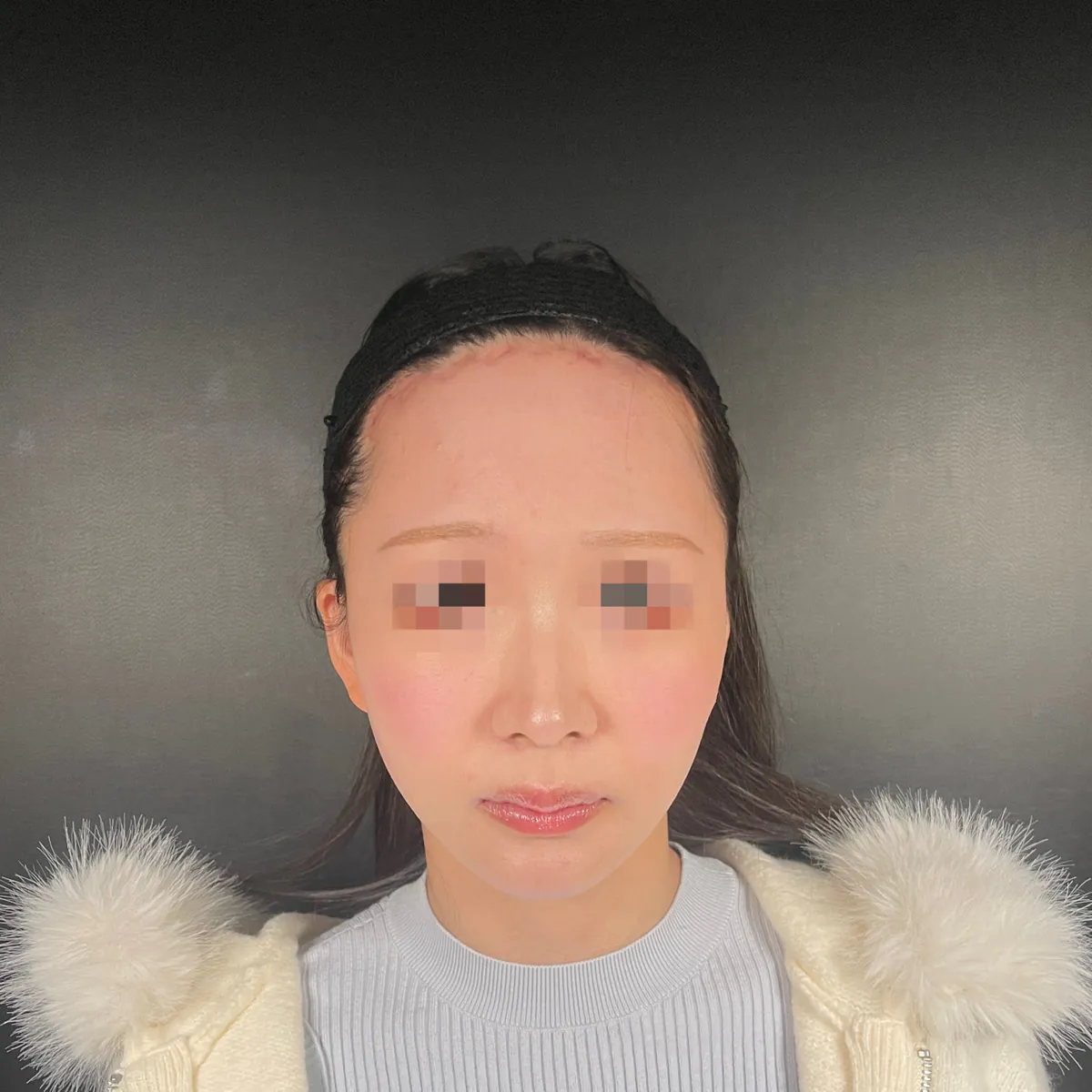 術前