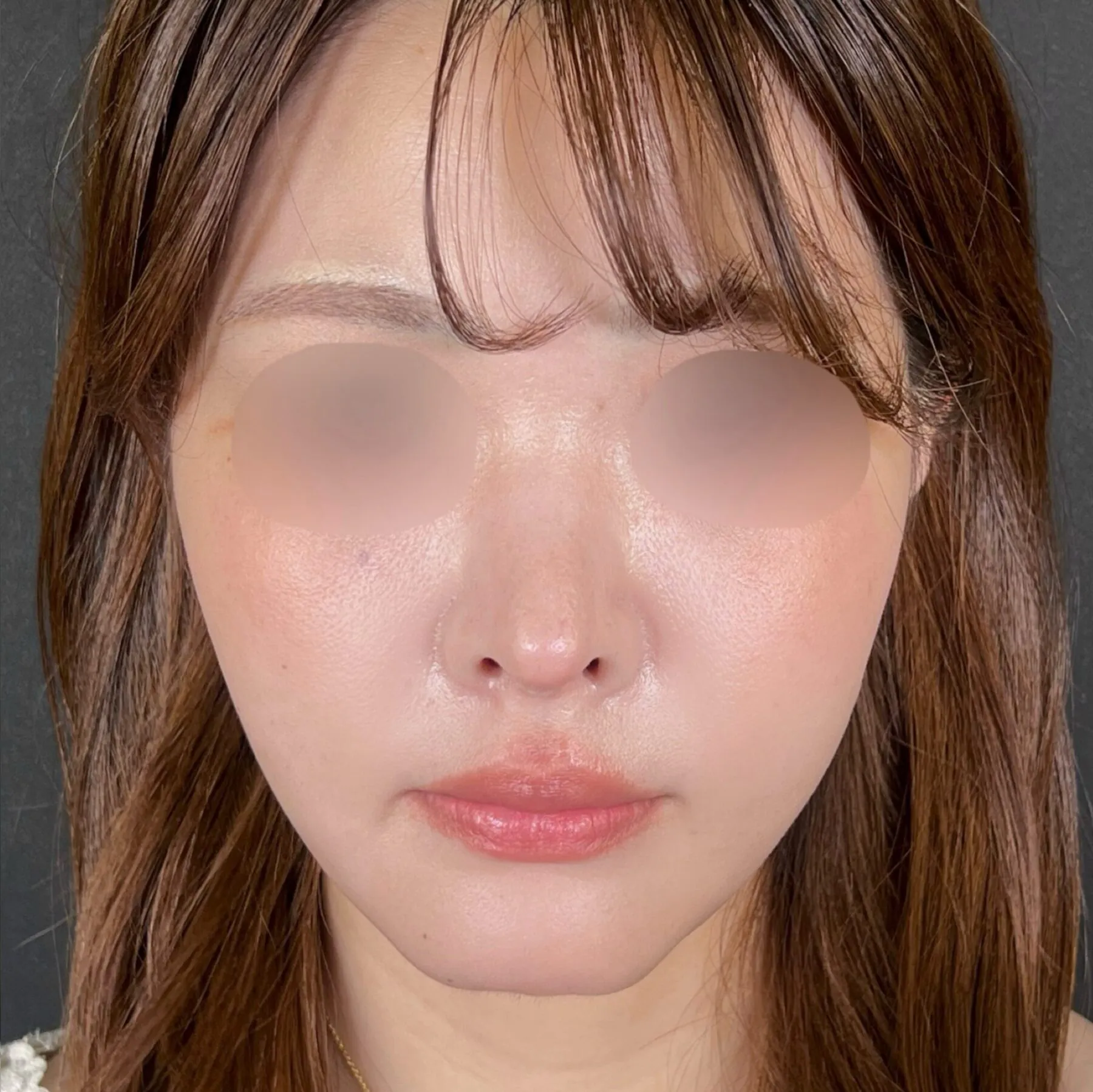 鼻の穴が見える状態を改善した症例