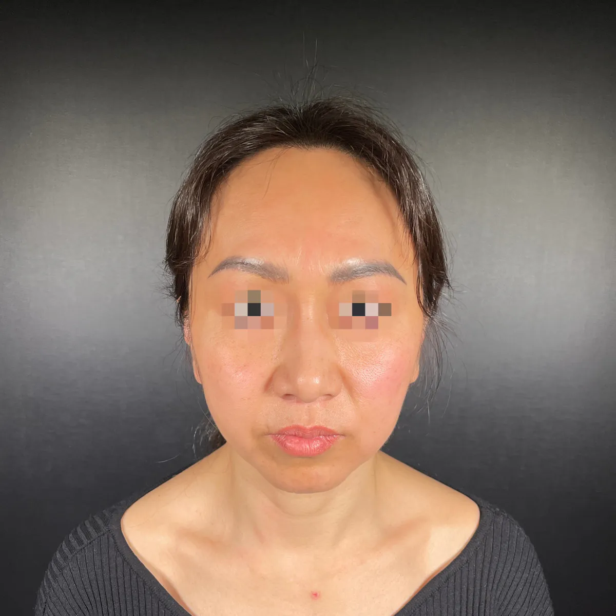 術前