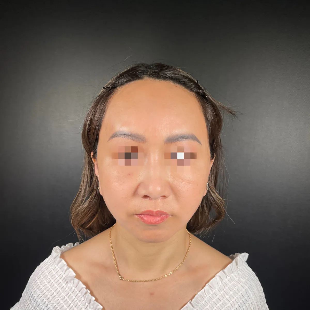 術前