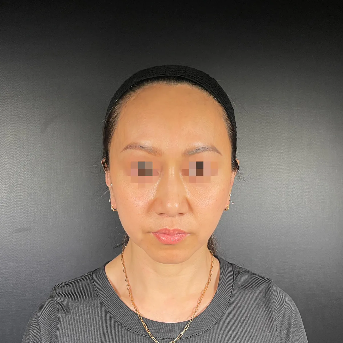 術前