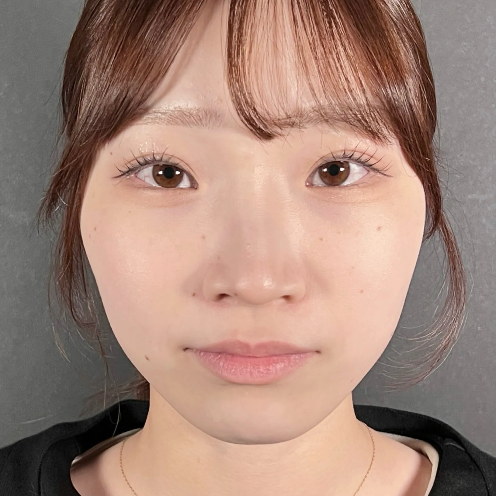 術前